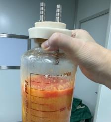 梁山水动力吸脂手术要做多久？